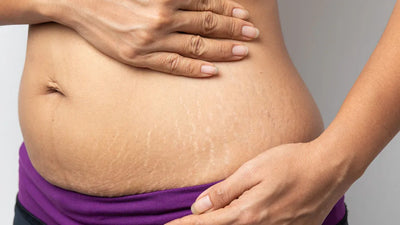 Preventing Stretch Marks and Varicose Veins