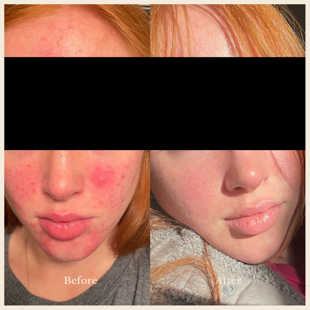 OBGYN-Approved, Multi-Tasking Serum for Acne-Prone Skin OBGYN-Approved, Multi-Tasking Serum for Acne-Prone Skin